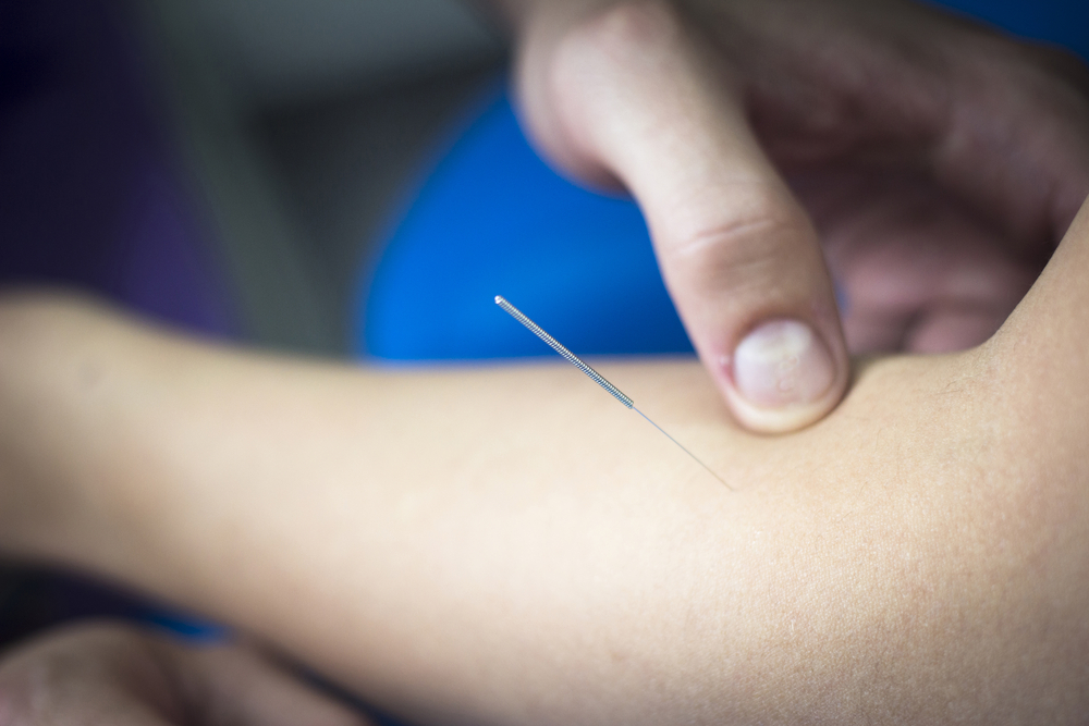 dry needling, How Can I Relieve Muscle Stiffness? 10 Reasons to Get Dry Needling